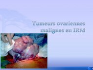 Tumeurs ovariennes en IRM - UBIR
