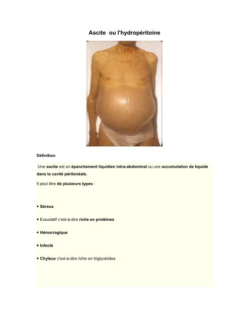 Ascite Ou L Hydroperitoine Cpoq