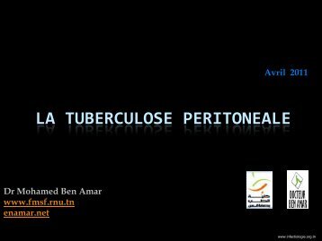 Particularités de la tuberculose péritonéale