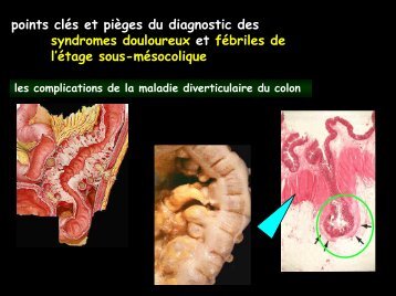 D C CT urgences étage sous mesocolique - RADIOLOGIE BRABOIS