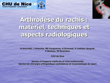 Arthrodèse du rachis : matériel, techniques et aspects radiologiques