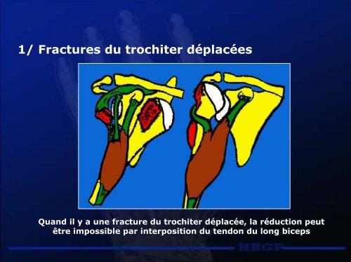 Luxations de l'épaule - RRMS