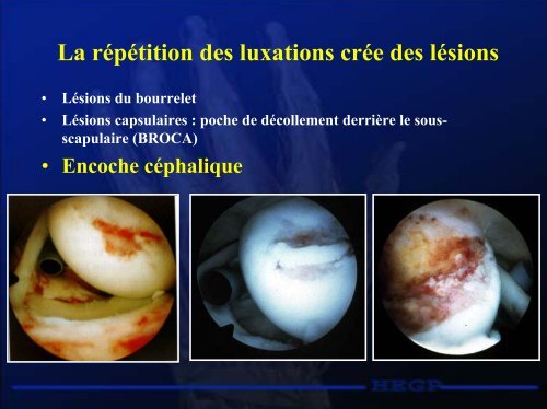 Luxations de l'épaule - RRMS