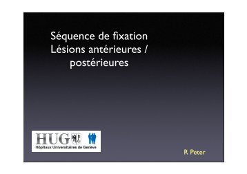 Séquence fixation antérieure/lésions postérieures