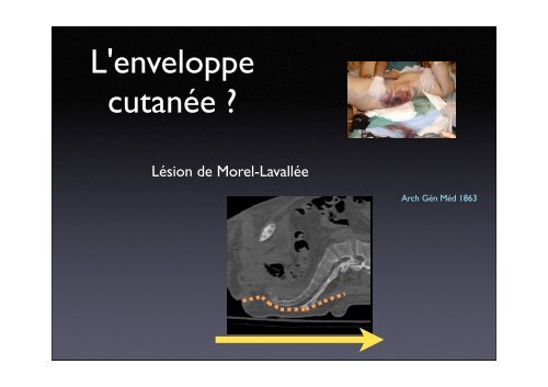 Séquence fixation antérieure/lésions postérieures