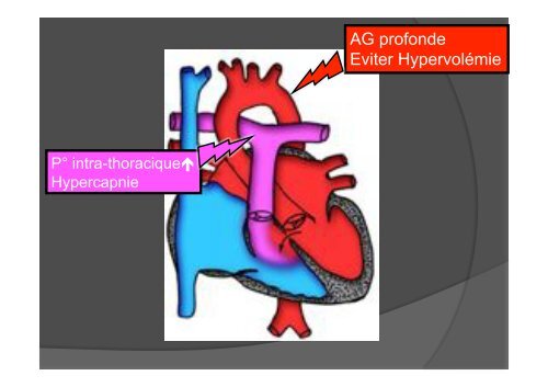 Anesthesie pour chirurgie non cardiaque chez ... - CHU - Montpellier