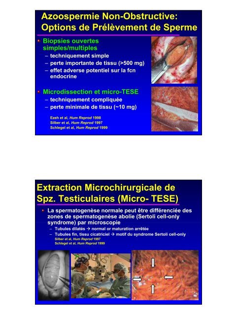 Azoospermie Obstructive