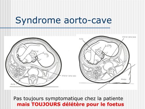 « Update » en Anesthésie-Analgésie Obstétricale - EIUA