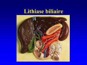 Lithiase biliaire - Infirmiers.com