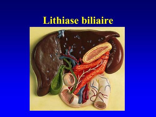 Lithiase biliaire - Infirmiers.com