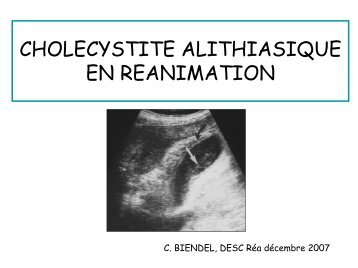 Cholécystite alithiasique en réanimation
