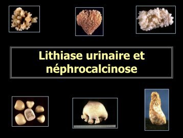 D C uro 04 lithiases urinaires - RADIOLOGIE BRABOIS