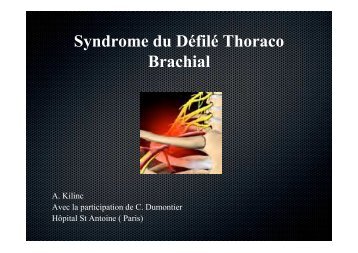 Syndrome du Défilé Thoraco Brachial - ClubOrtho.fr