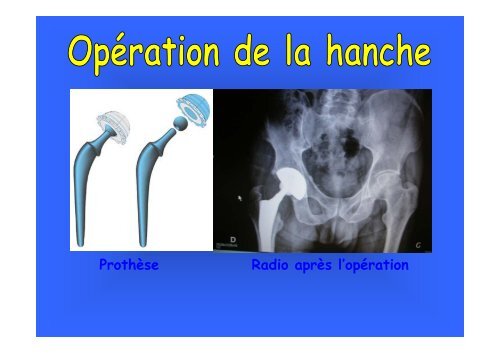 Que faire et ne pas faire juste après une prothèse de hanche.