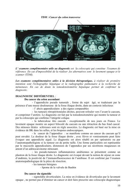 CANCER DU COLON - docvadis