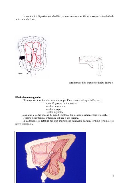 CANCER DU COLON - docvadis