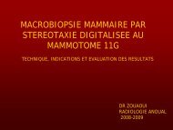 MACROBIOPSIE MAMMAIRE PAR STEREOTAXIE DIGITALISEE AU ...