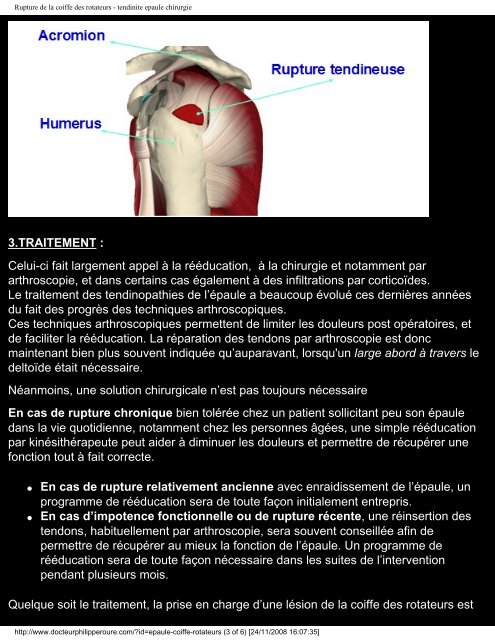 Rupture des Tendons de la coiffe des rotateurs - Dr Philippe Roure ...