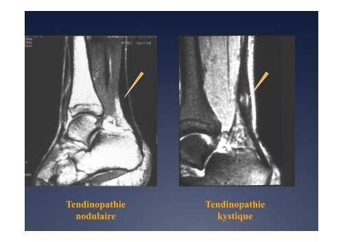 T. Cucurulo. Tendinopathies des membres inférieurs - ICOS 13