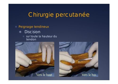 T. Cucurulo. Tendinopathies des membres inférieurs - ICOS 13