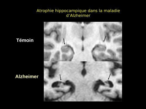 Imagerie cérébrale actuelle du sujet âgé (Dr. RODRIGO)