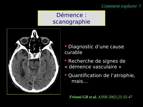 Imagerie cérébrale actuelle du sujet âgé (Dr. RODRIGO)