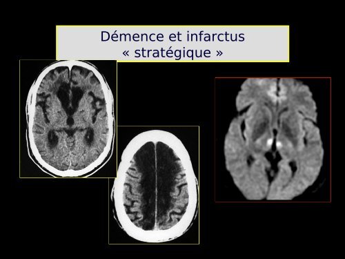 Imagerie cérébrale actuelle du sujet âgé (Dr. RODRIGO)