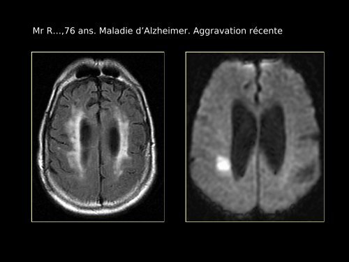 Imagerie cérébrale actuelle du sujet âgé (Dr. RODRIGO)