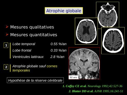 Imagerie cérébrale actuelle du sujet âgé (Dr. RODRIGO)