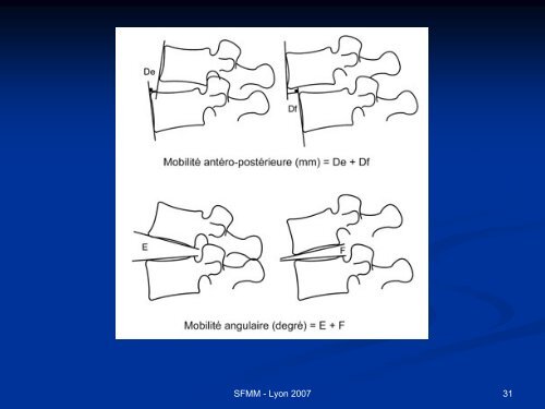 INSTABILITE VERTEBRALE TRAITEMENT ORTHOPEDIQUE ...