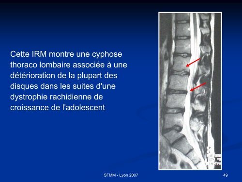 INSTABILITE VERTEBRALE TRAITEMENT ORTHOPEDIQUE ...