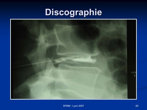 INSTABILITE VERTEBRALE TRAITEMENT ORTHOPEDIQUE ...