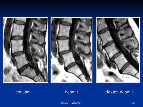 INSTABILITE VERTEBRALE TRAITEMENT ORTHOPEDIQUE ...