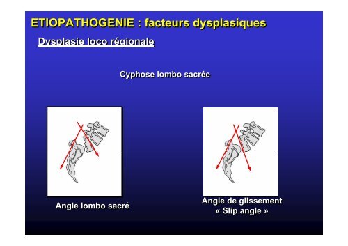 Spondylolisthésis - JL Jouve - SOFOP