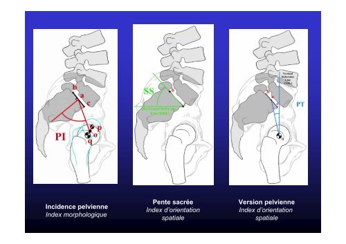 Spondylolisthésis - JL Jouve - SOFOP