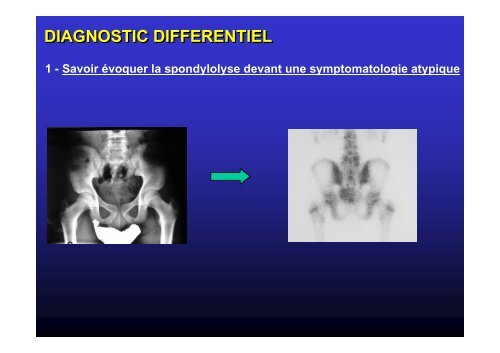 Spondylolisthésis - JL Jouve - SOFOP