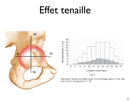 Le conflit femoro acétabulaire