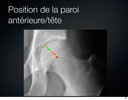 Le conflit femoro acétabulaire