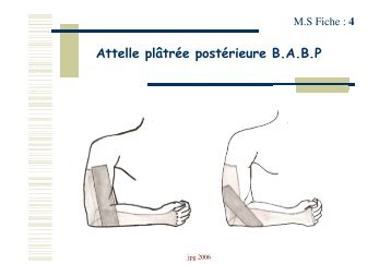 Attelle plâtrée postérieure B.A.B.P - COLMU