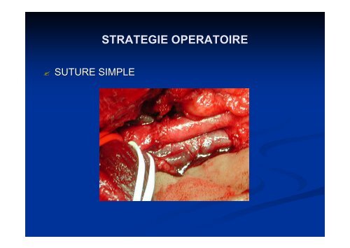 TRAUMATISMES OSTEO-VASCULAIRE DES MEMBRES