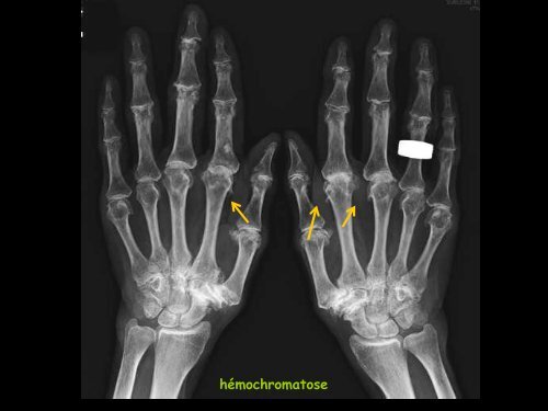 ECN 225 arthropathies microcristallines - RADIOLOGIE BRABOIS