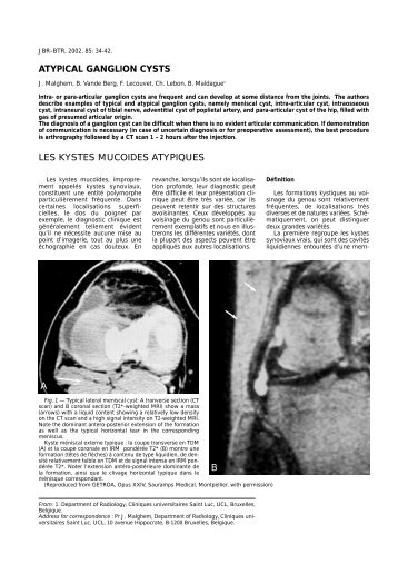 ATYPICAL GANGLION CYSTS LES KYSTES MUCOIDES ... - rbrs