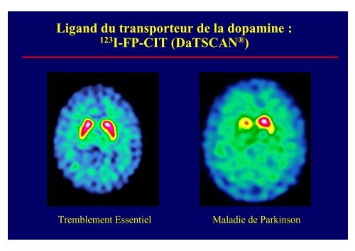 Tremblement et mouvements anormaux - Medco 59 62