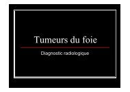 Tumeurs du foie interne - UBIR