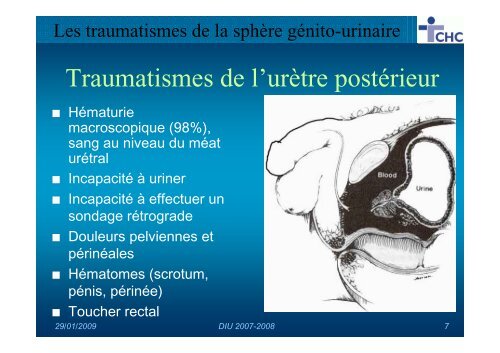 Les traumatismes de la sphère génito-urinaire - UCL Imaging
