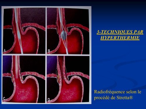 diaporama - chirurgie viscérale de l'ouest