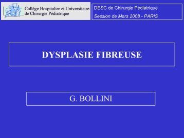 Dysplasie fibreuse – G BOLLINI - SOFOP