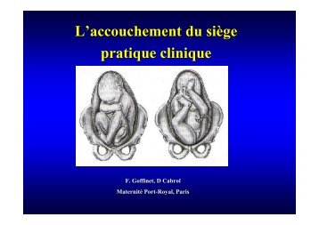 L'accouchement du siège pratique clinique