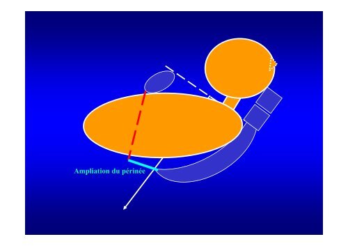 L'accouchement du siège pratique clinique