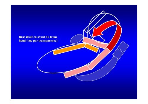 L'accouchement du siège pratique clinique